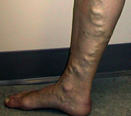 Varicose Veins Treatment in Mumbai
