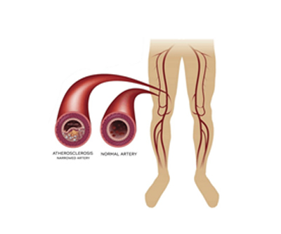 Peripheral Arterial Disease