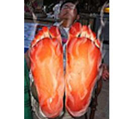 Peripheral Arterial Disease