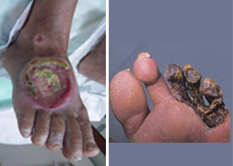 Peripheral Arterial Disease