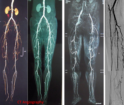 Peripheral Arterial Disease