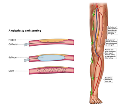 Peripheral Arterial Disease